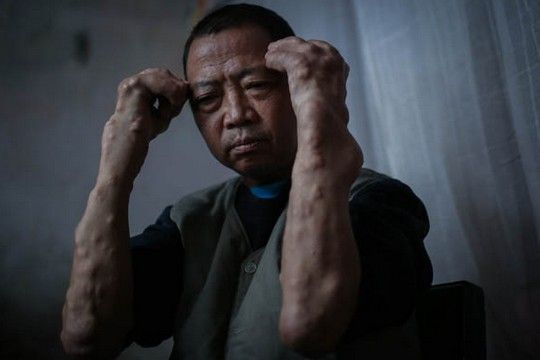 镉中毒会使人的骨骼生长代谢受阻碍,从而造成骨骼疏松、萎缩、变形等。